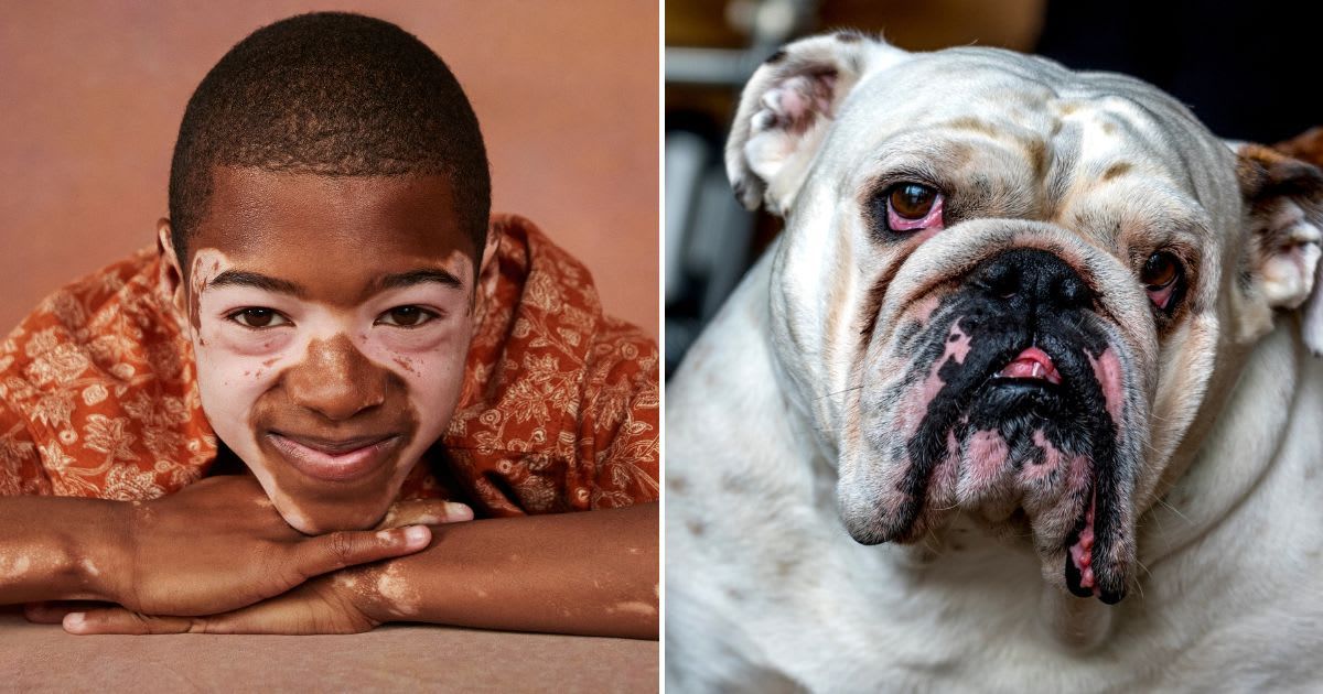 (L) Smiling boy with vitiligo, (R) Close-up portrait of bulldog. Representative Image Source: Getty Images | (L) Klaus Vedfelt, (R) Michael Roberts